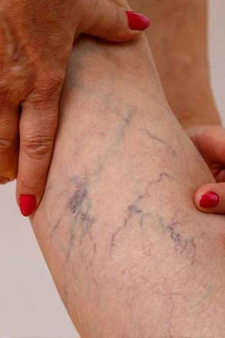 Varicose Veins Leg